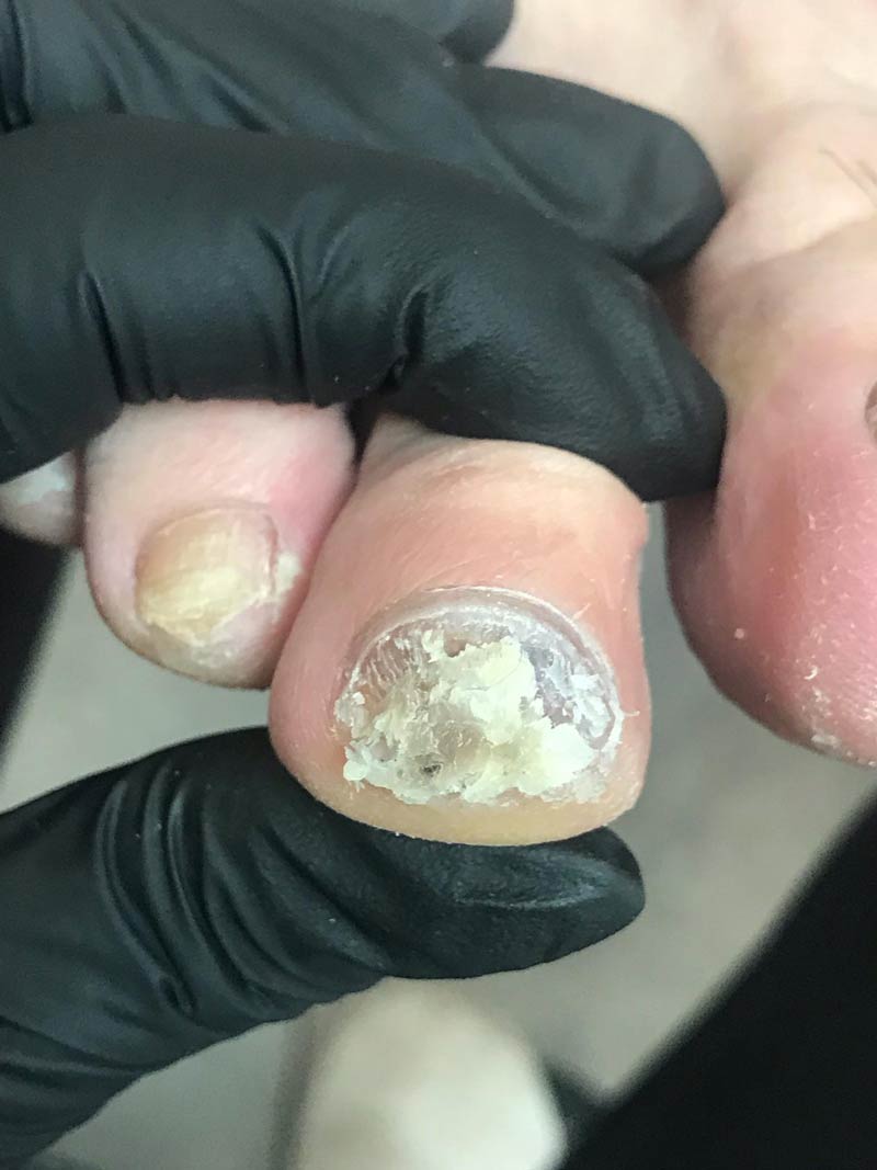 bakteryjne zakażenie paznokc