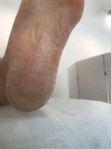 sucha skóra stóp