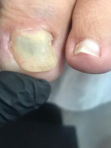 PodoCenter leczenie zielonych paznokci
